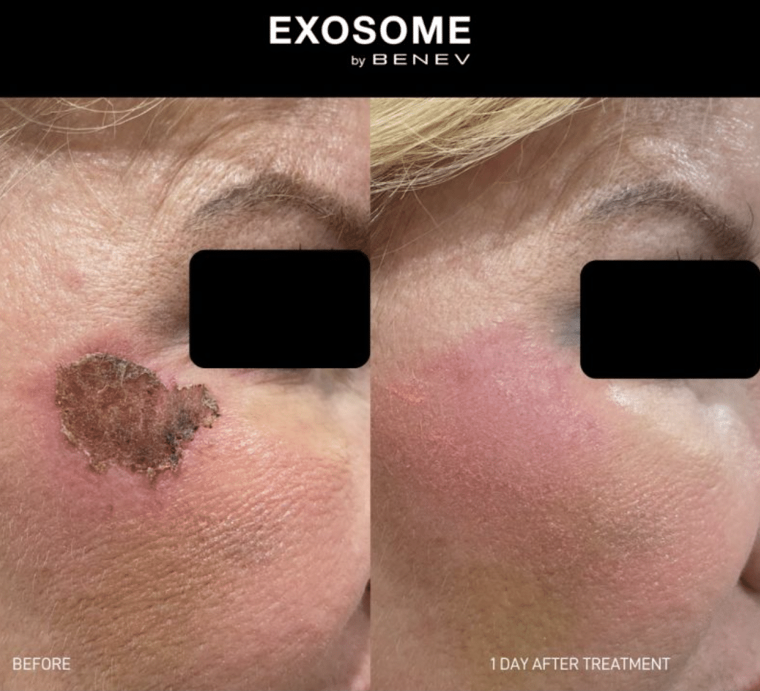 regenerate skin with exosomes